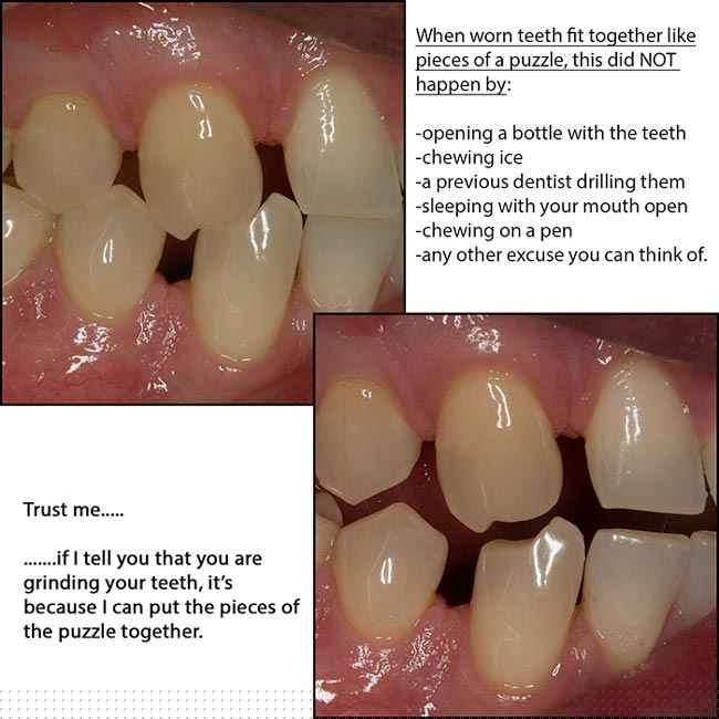 Why Do I Grind My Teeth?